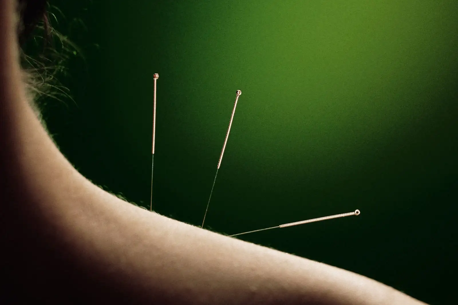Cosmetic/ Facial Acupuncture